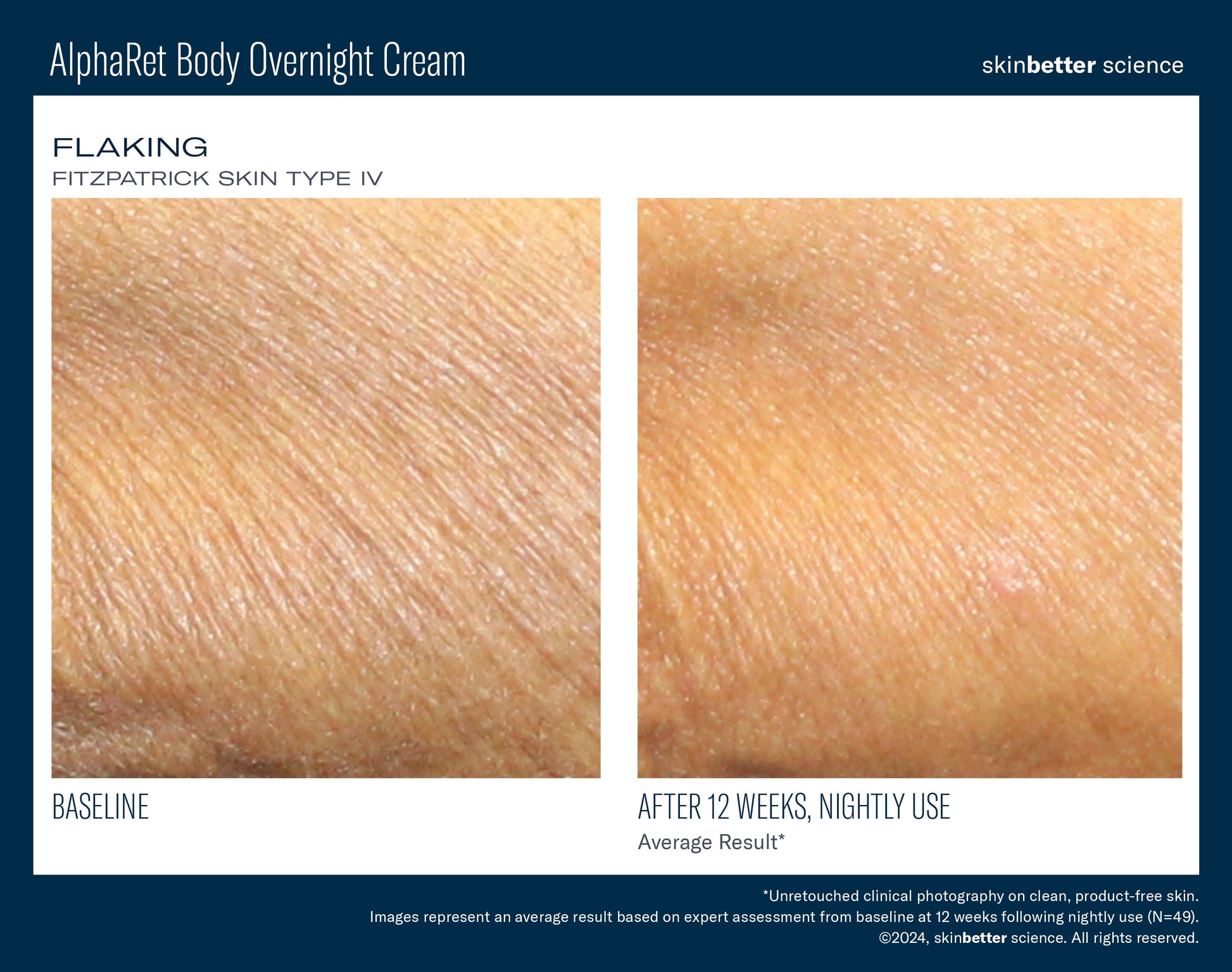 AlphaRet Body Overnight Cream